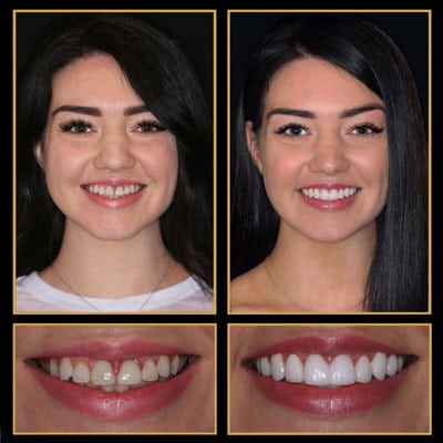 Patient's smile transformation before and after, highlighting The Cosmetic Dentists of Austin's 'Last Time You Pay' policy.