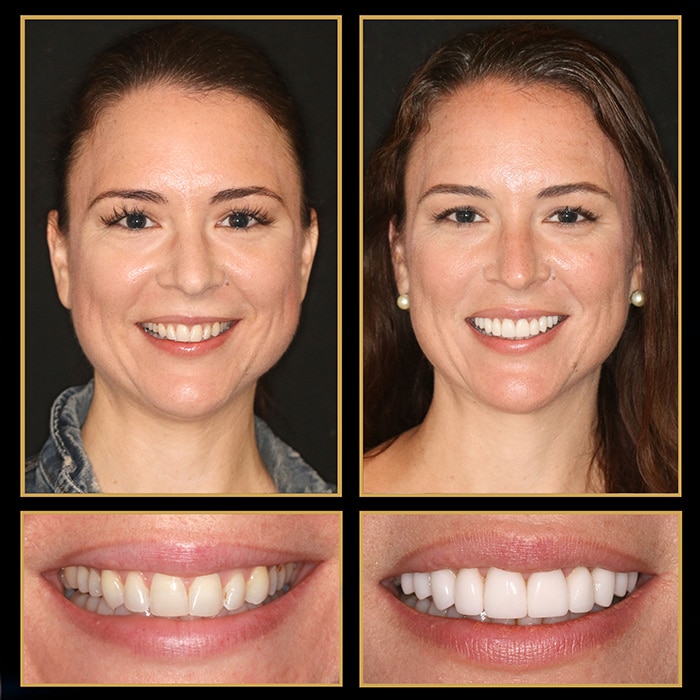 Before and after transformation of brunette woman with veneers by The Cosmetic Dentists of Austin.