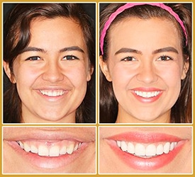 Gummy Smile Cosmetic Dentistry