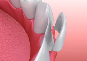 Diagram illustrating a porcelain veneer placement on a tooth by The Cosmetic Dentists of Austin.