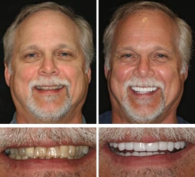 Find Out What Veneers Cost. Call Now For Veneers Cost
