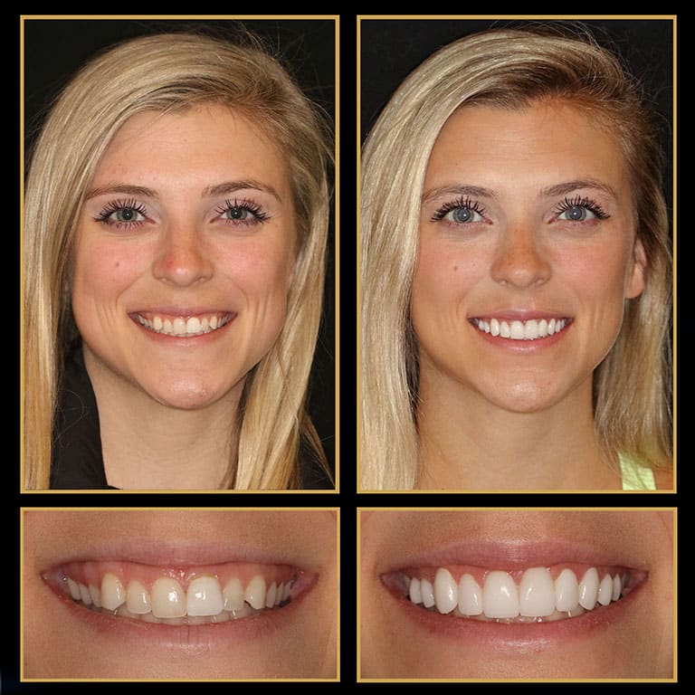 Amazing Smile Makeovers In Just Two Visits!