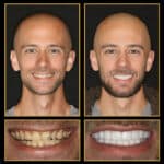 Get The Best Smile Makeover Call 512-333-7777 To Schedule Your Free Consult
