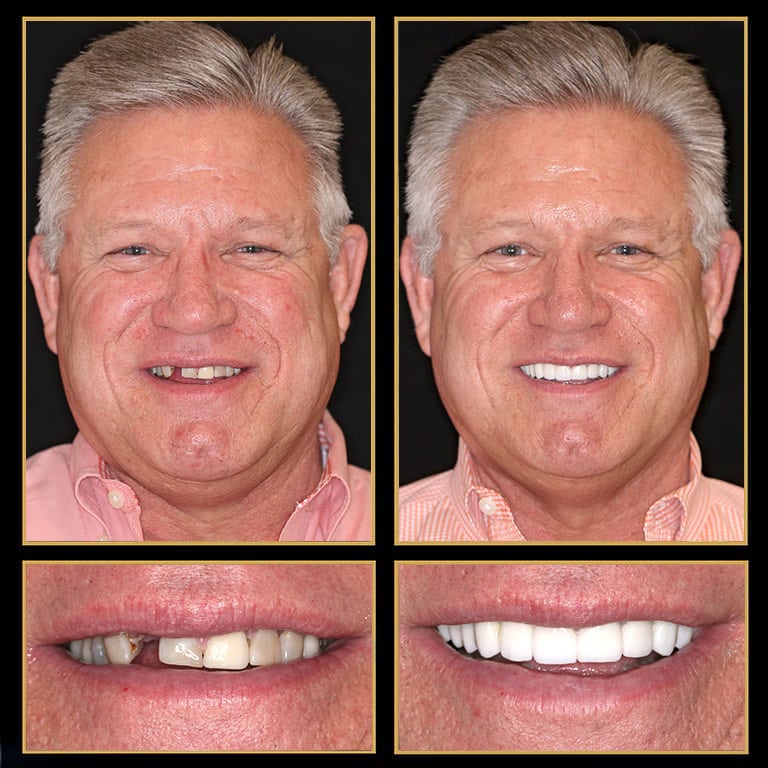 Five Star Reconstructive Dentistry By The Cosmetic Dentists of Austin. Call 512.333.7777 for A Free Consult
