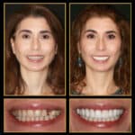 Get Dental Implants in Austin at The Cosmetic Dentists of Austin. Call 512.333.7777 for A Free Consult