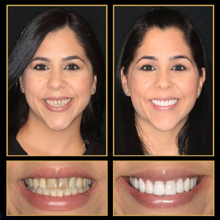 The Cosmetic Dentists of Austin will go out their way to help you can finance your veneers utilizing an easy payment plan through our financing partners