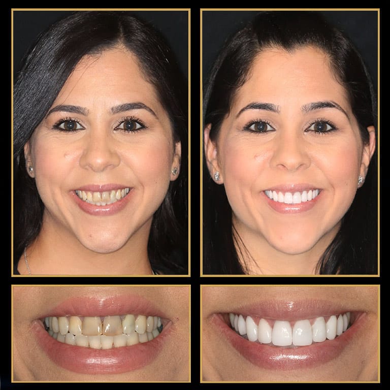 Make Your Smile Beautiful With A Full Mouth Reconstruction by Austin's best Dentist at The Cosmetic Dentists of Austin. Call 512.333.7777 for A Free Consult