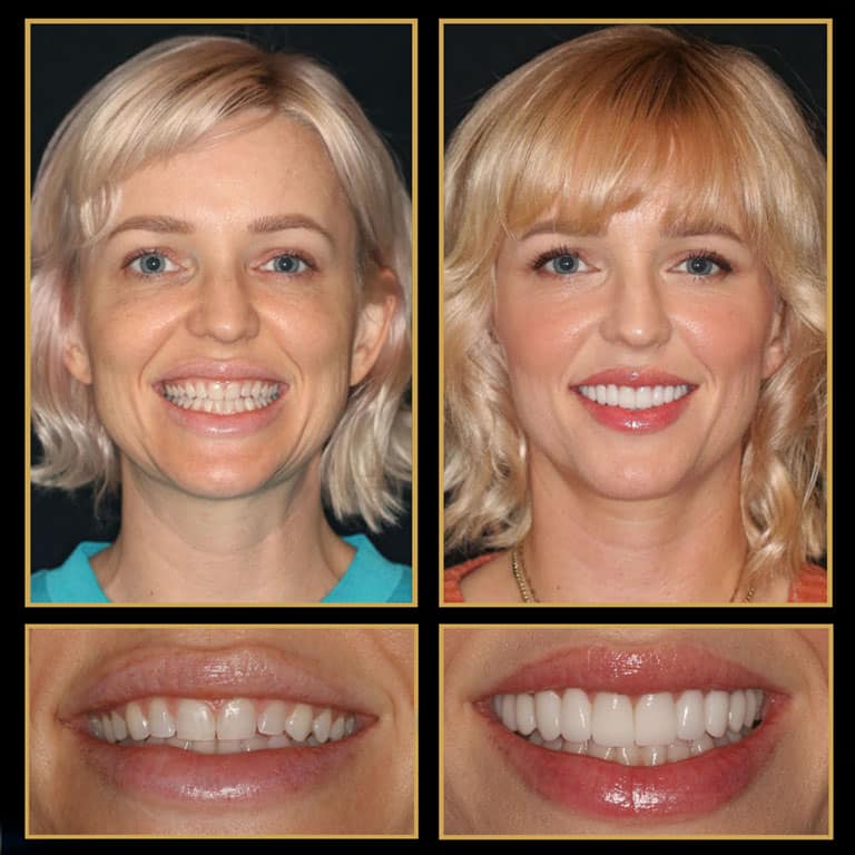 Amazing Smile makeovers With Porcelain Veneers by The Cosmetic Dentists of Austin