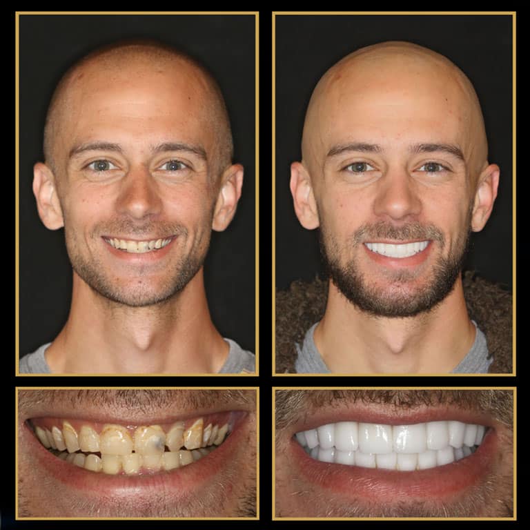 Stunning Natural Looking Veneers from The Cosmetic Dentists of Austin